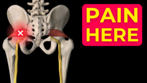 Piriformis Muscle Pain